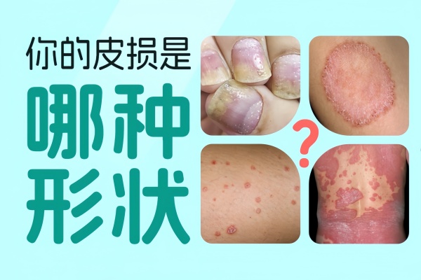 全面剖析：解读银屑病物理疗法的分类、应用及进展！
